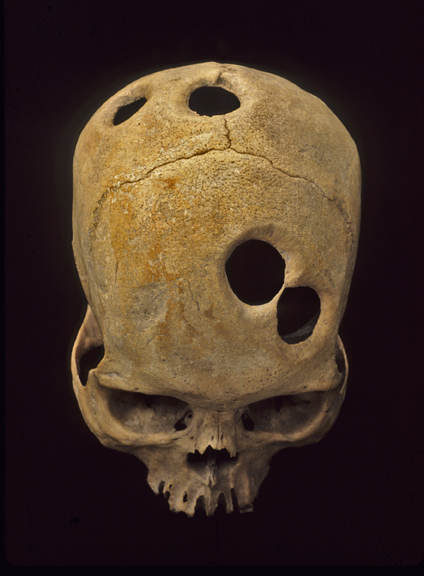 Inca skull with multiple healed trepanations (Photo provided by John Verano)